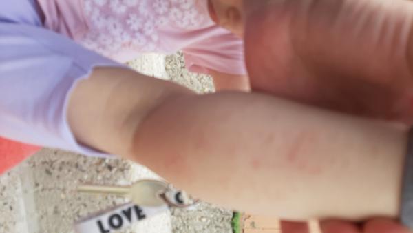 Ide o alergickú reakciu?