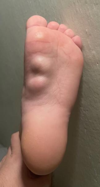 Výrastky na chodidle