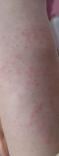 Čo spôsobilo výsyp na nohách a ako ho liečiť?