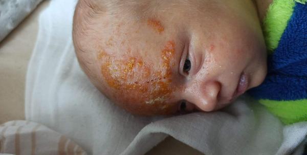 Hnisavé čelo u mesačného chlapčeka