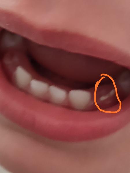 Synovi sa prerezáva očný zub a niečo biele sa mu vytvorilo na ďasne. Čo to je?