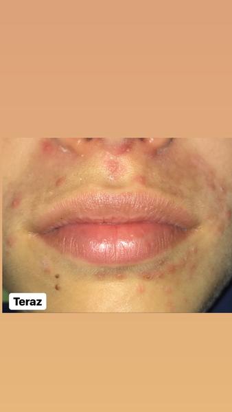 Vyrážky okolo úst a nosa. Vyteká z nich žltá vodička.