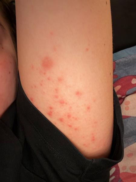 Ako riešiť vyrážky v tehotenstve bez kortikoidov?