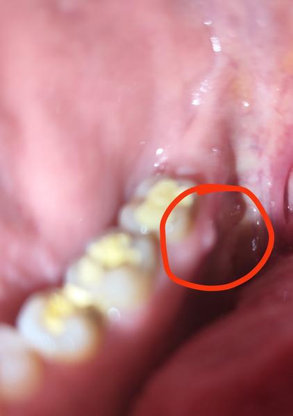 Ako sa zbaviť fistuly na ďasne a bolesti?