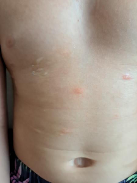 Môže byť alergia na slnko príčinou vyrážok?