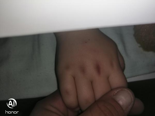 Modrinky po odbere krvi