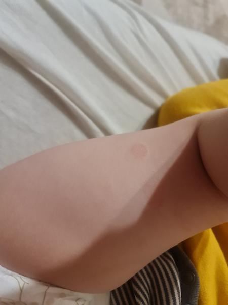 Mali aj vaše deti podobné kožné problémy?