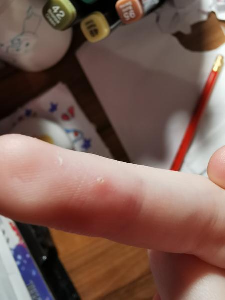 Je to kurie oko alebo bradavica na prste?