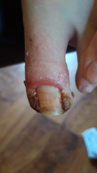 Ako liečiť neurodermitídu u mladistvých?