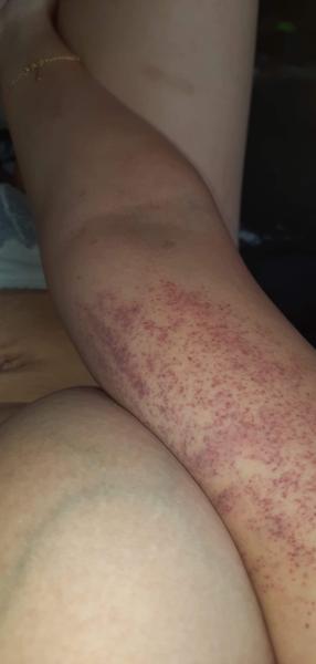 Krvné zrazeniny po škriabaní rúk