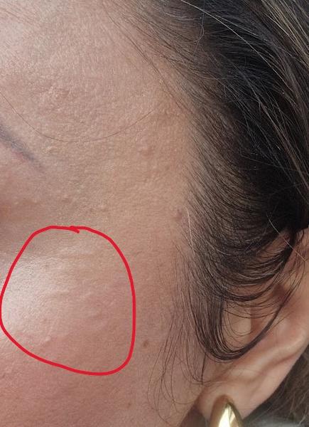 Zmiznú mi hrčky po aplikácii kyseliny hyalurónovej?