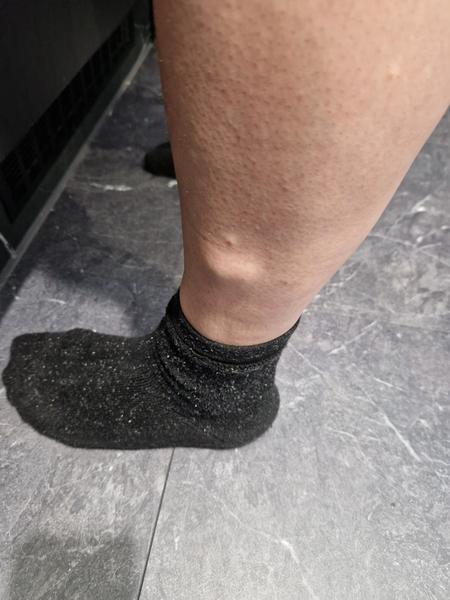 Čo spôsobuje hrbolky na lýtkach?