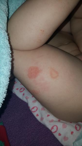 Červené svrbivé fľaky na nožičkách