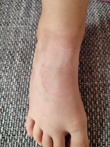 Ohraničený fľak na nohe