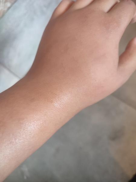 Čo robiť, keď uštipne včela?