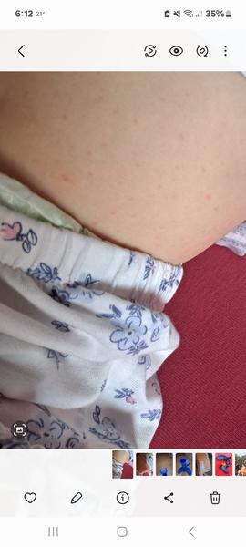 Čo môže spôsobiť červené bodky na brušku dcéry?