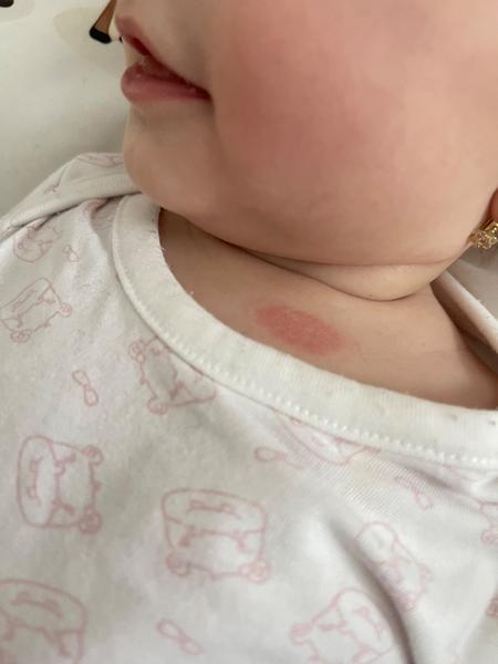 Z čoho sa 7-mesačnej dcérke objavil fľak nad hrudníkom?