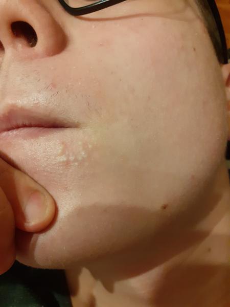 Ako riešiť dlhotrvajúce vyrážky u syna?