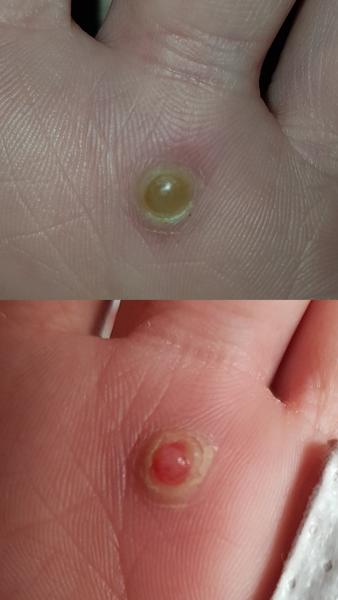 Zapálená bradavica