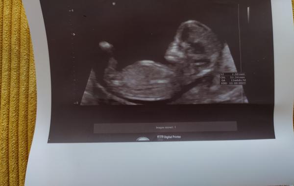 Je podľa fotky z ultrazvuku vidieť pohlavie môjho dieťatka?