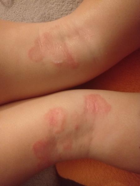 Má moje dieťa normálny prejav atopického ekzému?