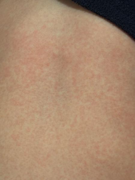 Je to šiesta choroba?