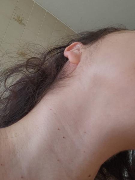 Tvrdá hrčka na krku