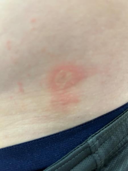 Čo sú to za vyrážky?