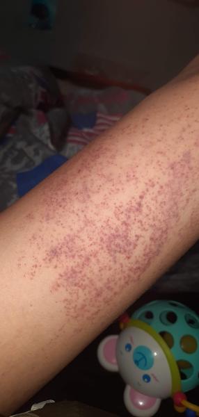 Krvné zrazeniny po škriabaní rúk