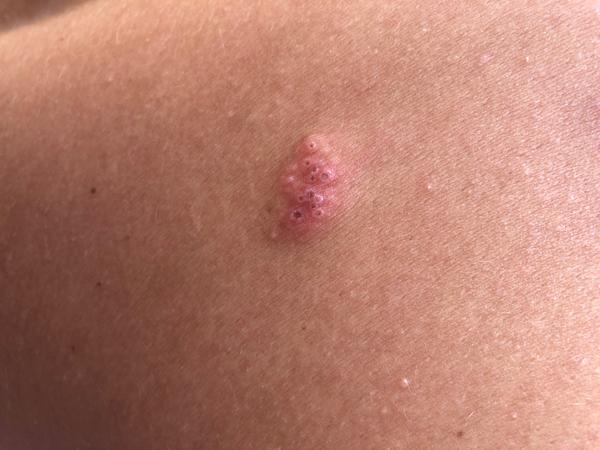 Od čoho mám štípanec?