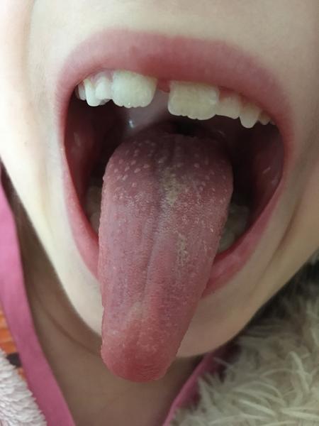 Je to šarlach, alebo iné ochorenie?