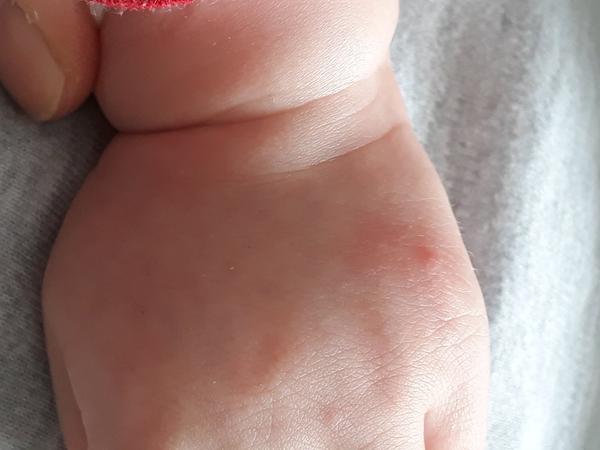 Vyrážky u 8 mesačného syna