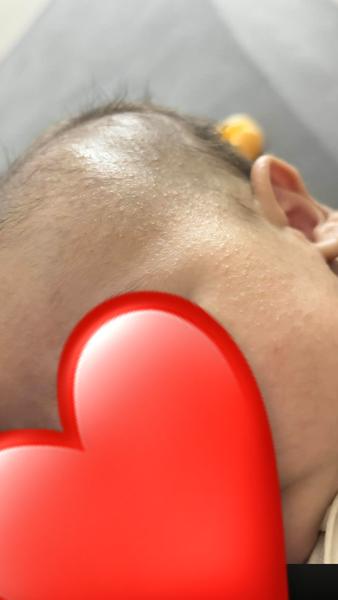 Ako rozoznať detské akné od ekzému?