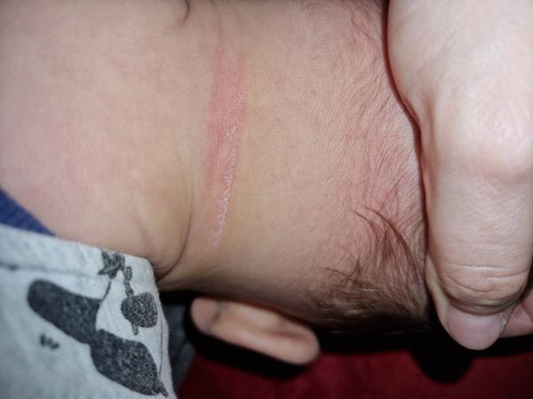 Môže biely film na koži znamenať zdravotný problém?