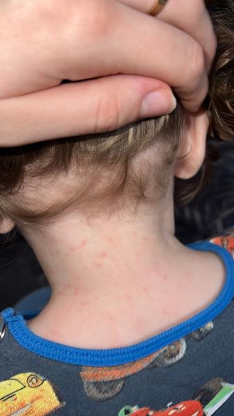 Má môj 10-mesačný syn potničky?