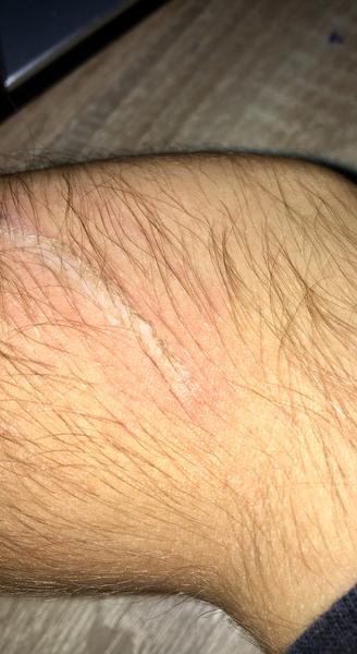 Ako mám riešiť popáleninu?