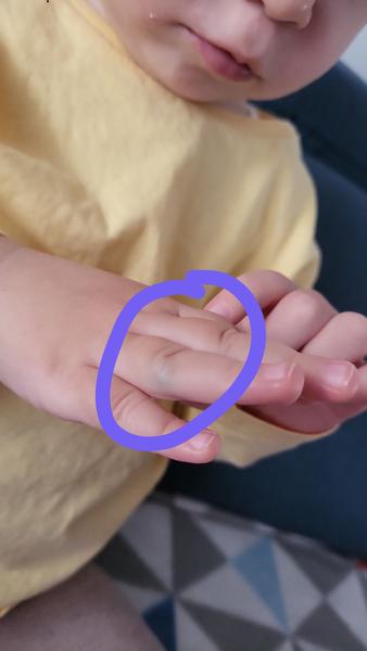 Z čoho sa dcérke vytvorila takáto žilka na pršteku?