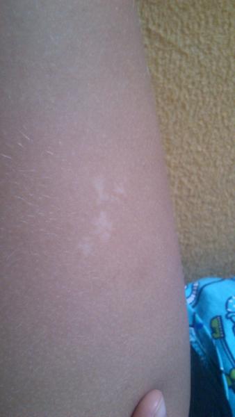 Je to vitiligo?