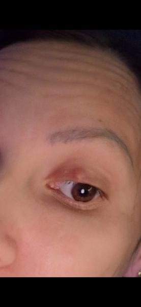 Výrastok na viečku