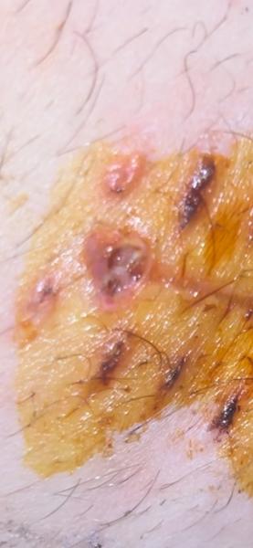 Otvorená jazva po operácii