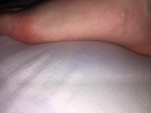 Bolesť chodidla - mám zápal šliach?