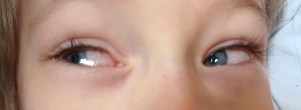 Je to prejav alergie u vášho dieťaťa?