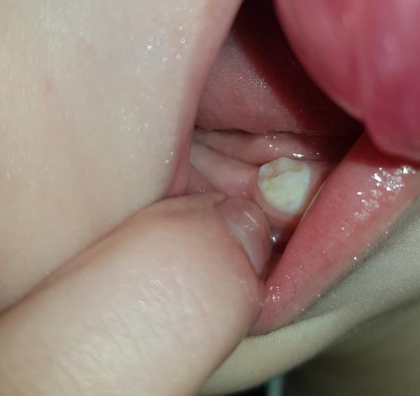 Čo je toto na zúbku 18 mesačného chlapčeka?