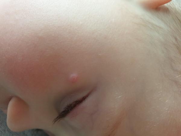 20 mesačný synček má pod okom už tri mesiace vyrážku. O aký problém ide?