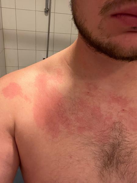 Čo spôsobuje červené flaky na krku a hrudi?