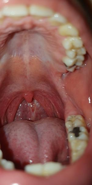 Ide o cystu na podnebí?