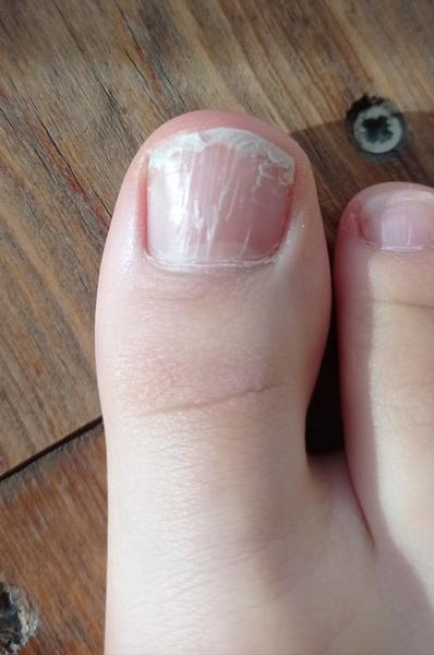 Prečo má dcérka popraskané nechty na palcoch?