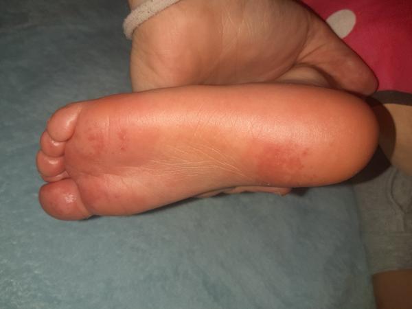 Aký výsyp má moje dieťa?