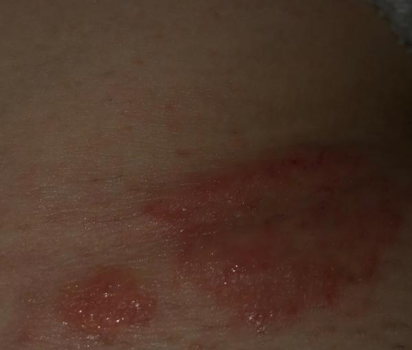 Vyrážka nad panvou