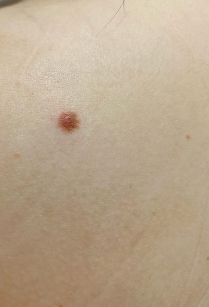 Rozškrabla som si znamienko